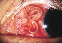 Chẩn đoán sớm, can thiệp kịp thời nhiễm ký sinh trùng và đơn bào ở cơ quan thị giác người 