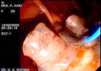 Một chẩn đoán dễ gây nhầm lẫn về khối giả u do sán lá gan lớn Fasciola hepatica/ Fasciola gigantica