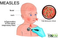 Sởi tiếp tục lây lan và cướp đi nhiều sinh mạng ở châu Âu
