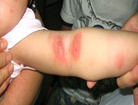 Viêm da do côn trùng đốt-chích: biểu hiện lâm sàng đến phòng bệnh