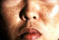 Sạm da toàn thân do bệnh Addison