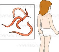 Phần 1: Điểm mới trong chẩn đoán & điều trị bệnh giun kim Enterobius vermicularis ở người