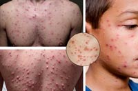 Làm thế nào biết được các triệu chứng của bệnh thủy đậu, điều trị và cách phòng ngừa?