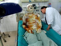 Bỏng là tổn thương cần được lưu ý phòng ngừa