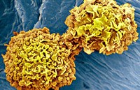 Ung thư vú “có thể tái phát trở lại trong vòng 15 năm sau khi điều trị kết thúc”