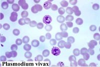 Liệu sinh học phân tử có thể phân biệt tái phát, tái nhiễm và kháng thuốc chloroquine do Plasmodium vivax?