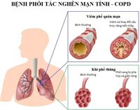 Thông tin mới về bệnh phổi tắc nghẽn mãn tính (COPD)