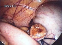 Q&A: Giun kim-Sự lan truyền, biện pháp phòng bệnh và điều trị  