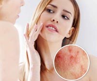 Bệnh ghẻ bao lông do Demodex canis ở chó vẫn có khả năng lây sang người !