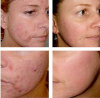 Hướng dẫn thực hành chẩn đoán, điều trị và phòng bệnh viêm da do Demodex spp.