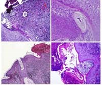 Chẩn đoán và điều trị bệnh viêm da do ký sinh trùng ở vùng nang lông tuyến bã