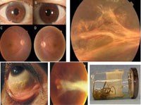 Các công trình nghiên cứu về chẩn đoán và điều trị bệnh giun đũa chó/ mèo ở người do Toxocara canis/ Toxocara cati