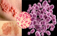 Bệnh lây truyền qua đường tình dục nguy hiểm do vi khuẩn lậu Neisseria gonorrhoeae & Clammydia trachomatis