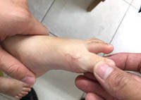 Nhân một trường hợp giả ấu trùng di chuyển gây sang thương ở da do sợi tóc