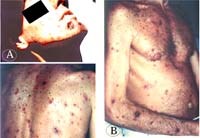 Lý giải lâm sàng về hội chứng herxheimer trong y học ký sinh trùng?