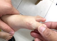 Nhân một trường hợp giả ấu trùng di chuyển gây sang thương ở da do sợi tóc