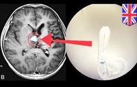 Bệnh ký sinh trùng sán nhái (Sparganosis) chưa được quan tâm tại Việt Nam