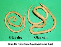 Cập nhật thông tin về tình hình nhiễm giun truyền qua đất