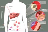 Phần 3: Sốt rét ác tính: nhiều vấn đề liên quan đến cơ chế vẫn chưa sáng tỏ