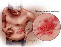 Bệnh thủy đậu: Một số thông tin cần biết để phòng tránh cho mọi người trong mùa hè-thu 