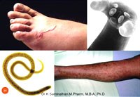 Bệnh ký sinh trùng lây truyền từ động vật sang người: Bệnh sán dây