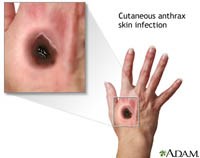 Một số thông tin cần thiết về bệnh than