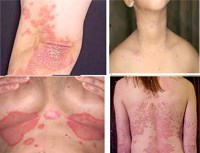 Thương tổn do bệnh vảy nến cần phân biệt với các bệnh ký sinh trùng