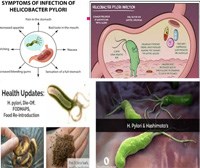 Cập nhật Hướng dẫn điều trị Helicobacter pylori từ Hiệp hội Tiêu hóa Mỹ ACG 2017