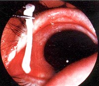 Phần 2. Điều trị theo phương cách dân gian có thể dẫn đến nhiễm ký sinh trùng sán nhái (sparganosis) tại Việt Nam