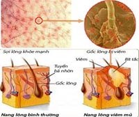 Phần 1. Cập nhật về chẩn đoán & điều trị bệnh viêm dày sừng nang lông