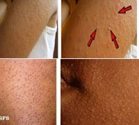 Phần 2. Cập nhật về chẩn đoán & điều trị bệnh viêm dày sừng nang lông 