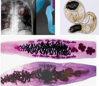 Phần 1: Cập nhật các ấn phẩm nghiên cứu về bệnh sán lá gan lớn, sán lá gan nhỏ ở người & mối quan tâm đến ung thư gan mật?