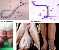  Nhân Ngày Việt Nam được chứng nhận loại trừ bệnh giun chỉ bạch huyết:  Cập nhật y văn  về bệnh giun chỉ bạch huyết