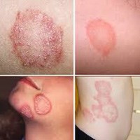 Phần 1: Chuyên mục trả lời hỏi đáp các bệnh ký sinh trùng và y học thường thức (Tháng 11-12/2018)