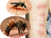 Làm thế nào để phòng tránh côn trùng đốt trẻ em trong mùa ẩm ướt?