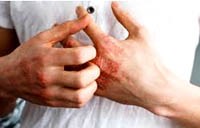 Chứng ngứa da của người cao tuổi và cách điều trị hiệu quả