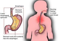 Một số câu hỏi liên quan đến triệu chứng đau bụng, đầy hơi và rối loại tiêu hóa