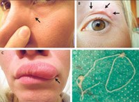 Q&A: Một số thông tin về giun chỉ Dirofilaria repens 