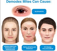 Cập nhật về ngoại ký sinh trùng Demodex spp. ở người