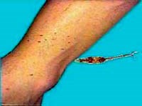 Bệnh sán máng (Schistosomiasis): Những thông tin về gánh nặng, sự lan truyền, các triệu chứng, chẩn đoán và biện pháp phòng chống bệnh của Tổ chức Y tế thế giới năm 2020.