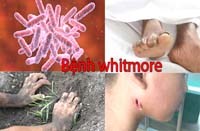 Thông tin cần biết về bệnh Melioidosis (Whitmore)
