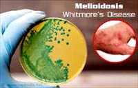 Tổng quan cập nhật về bệnh vi khuẩn ăn thịt người Melioidosis