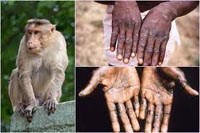 Bệnh đậu mùa khỉ ở người- MONKEYPOX 