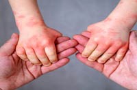 Một số rối loạn ở da niêm mạc khi thời tiết thay đổi cần phân biệt với bệnh da do ký sinh trùng 