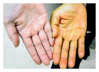 Đánh giá vàng da ở người trưởng thành liên quan và không liên quan đến bệnh lý gan mật_Phần 2