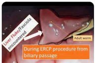 Phần 2: Phát triển và ứng dụng chẩn đoán hình ảnh trong chẩn đoán và điều trị bệnh sán lá gan lớn ờ người