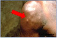 Phấn 2. Cập nhật điều trị và quản lý ca bệnh ấu trùng sán dây lợn thể thần kinh từ Tổ chức Y tế  Thế giới