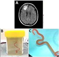  Cập nhật về ca bệnh phát hiện nhiễm loài giun tròn mới trên hệ thần kinh trung ương của ngưới (Phần 1)