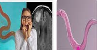   Cập nhật về ca bệnh phát hiện nhiễm loài giun tròn mới trên hệ thần kinh trung ương của ngưới (Phần 2)