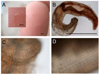 Ấu trùng  Gnathostoma  spp. di chuyển dưới da và phủ tạng (Phần 1)